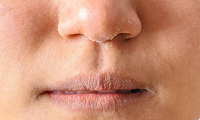 Dấu hiệu và cách chữa trị bệnh chàm môi